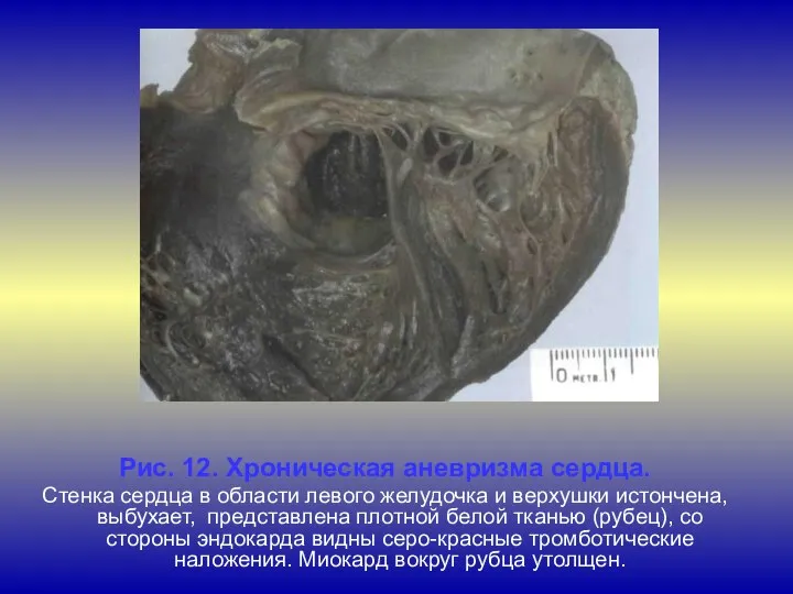 Рис. 12. Хроническая аневризма сердца. Стенка сердца в области левого желудочка