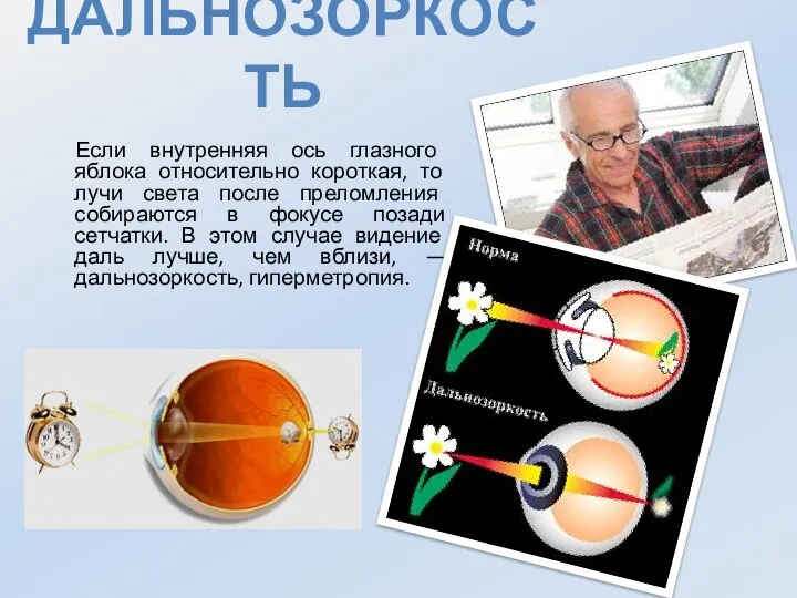 Дальнозоркость Если внутренняя ось глазного яблока относительно короткая, то лучи света