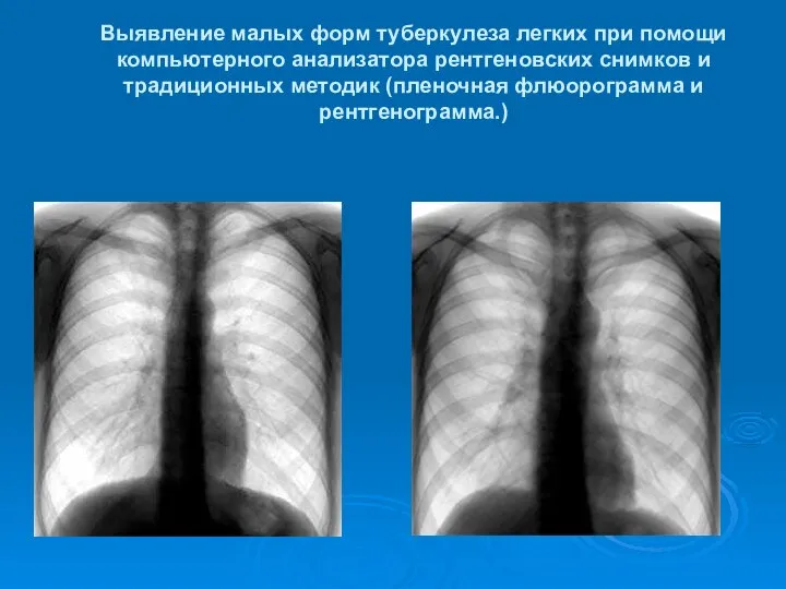 Выявление малых форм туберкулеза легких при помощи компьютерного анализатора рентгеновских снимков