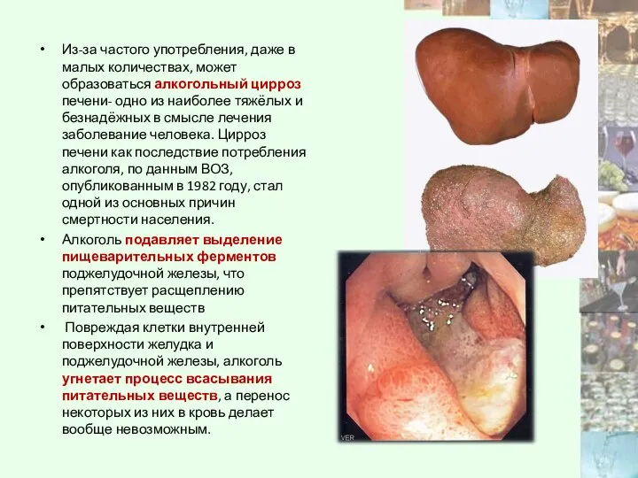 Из-за частого употребления, даже в малых количествах, может образоваться алкогольный цирроз