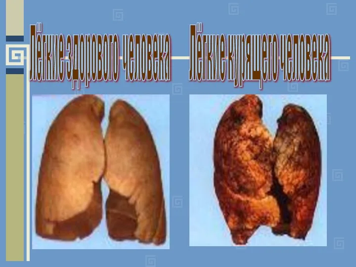 Лёгкие здорового человека Лёгкие курящего человека