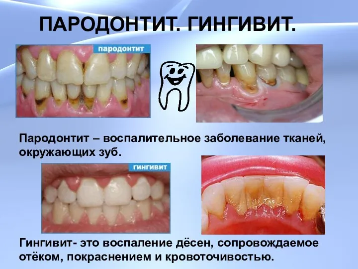 ПАРОДОНТИТ. ГИНГИВИТ. ПАРОДОНТИТ. ГИНГИВИТ. Пародонтит – воспалительное заболевание тканей, окружающих зуб.