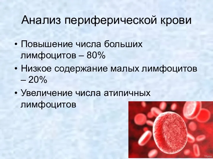 Анализ периферической крови Повышение числа больших лимфоцитов – 80% Низкое содержание