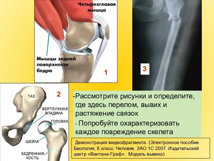 1 2 Рассмотрите рисунки и определите, где здесь перелом, вывих и