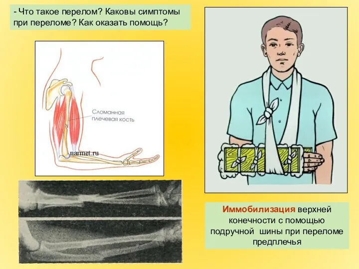 Иммобилизация верхней конечности с помощью подручной шины при переломе предплечья -