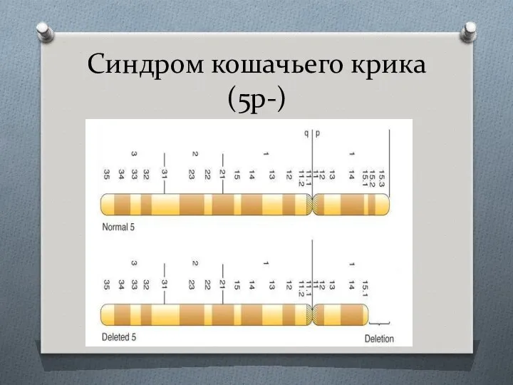 Синдром кошачьего крика (5р-)