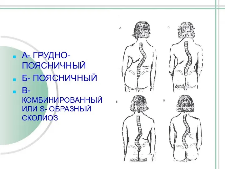 А- ГРУДНО-ПОЯСНИЧНЫЙ Б- ПОЯСНИЧНЫЙ В- КОМБИНИРОВАННЫЙ ИЛИ S- ОБРАЗНЫЙ СКОЛИОЗ