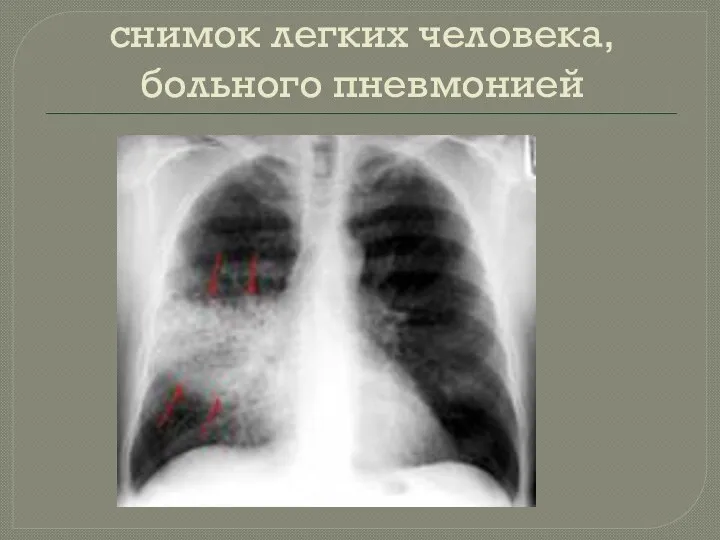 снимок легких человека, больного пневмонией