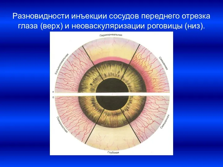 Разновидности инъекции сосудов переднего отрезка глаза (верх) и неоваскуляризации роговицы (низ).