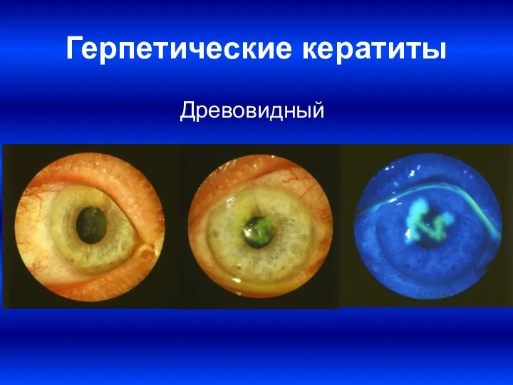 Герпетические кератиты Древовидный