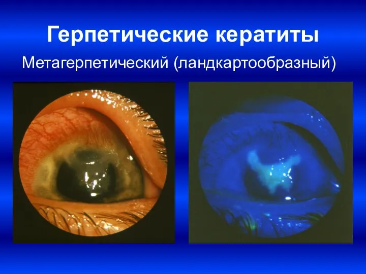 Герпетические кератиты Метагерпетический (ландкартообразный)