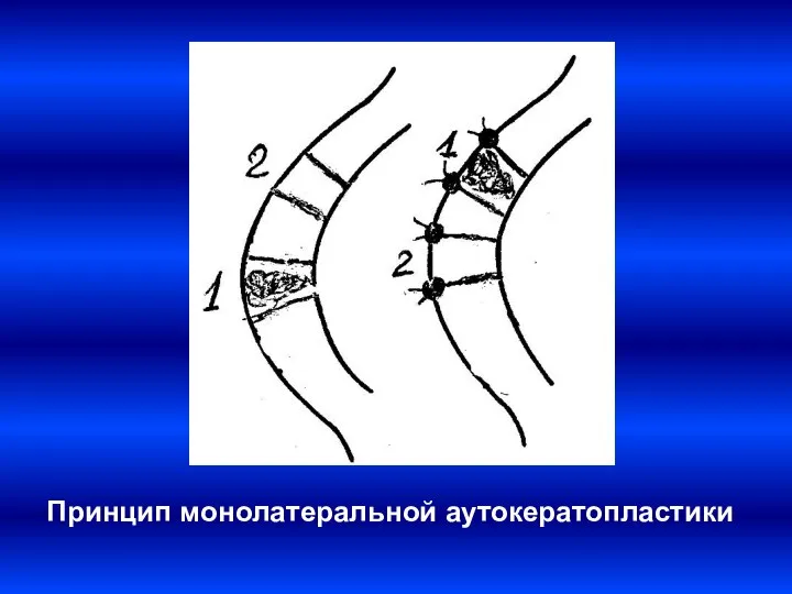 Принцип монолатеральной аутокератопластики