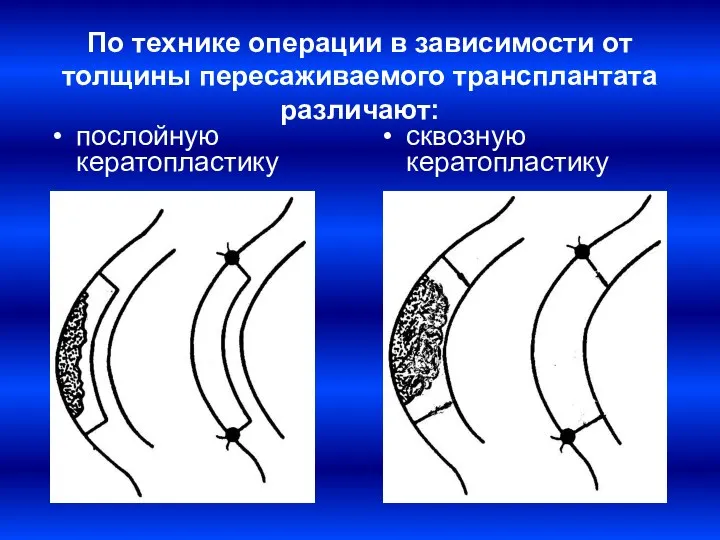 По технике операции в зависимости от толщины пересаживаемого трансплантата различают: послойную кератопластику сквозную кератопластику