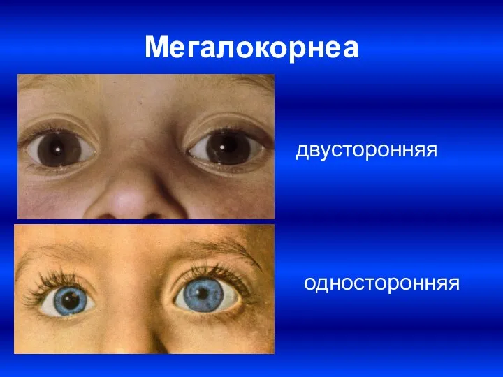 Мегалокорнеа двусторонняя односторонняя