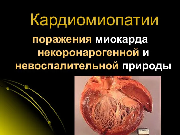 Кардиомиопатии поражения миокарда некоронарогенной и невоспалительной природы