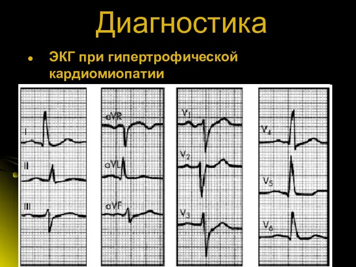 Диагностика ЭКГ при гипертрофической кардиомиопатии