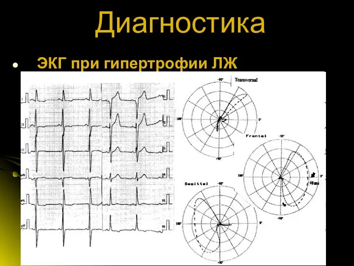 Диагностика ЭКГ при гипертрофии ЛЖ