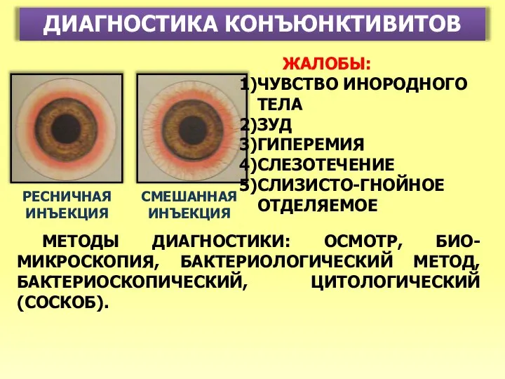 ДИАГНОСТИКА КОНЪЮНКТИВИТОВ РЕСНИЧНАЯ ИНЪЕКЦИЯ СМЕШАННАЯ ИНЪЕКЦИЯ ЖАЛОБЫ: ЧУВСТВО ИНОРОДНОГО ТЕЛА ЗУД