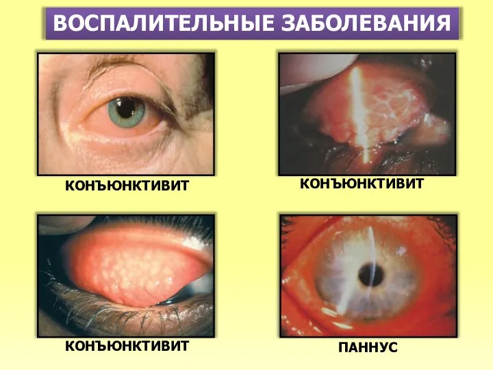 ВОСПАЛИТЕЛЬНЫЕ ЗАБОЛЕВАНИЯ КОНЪЮНКТИВИТ ПАННУС КОНЪЮНКТИВИТ КОНЪЮНКТИВИТ