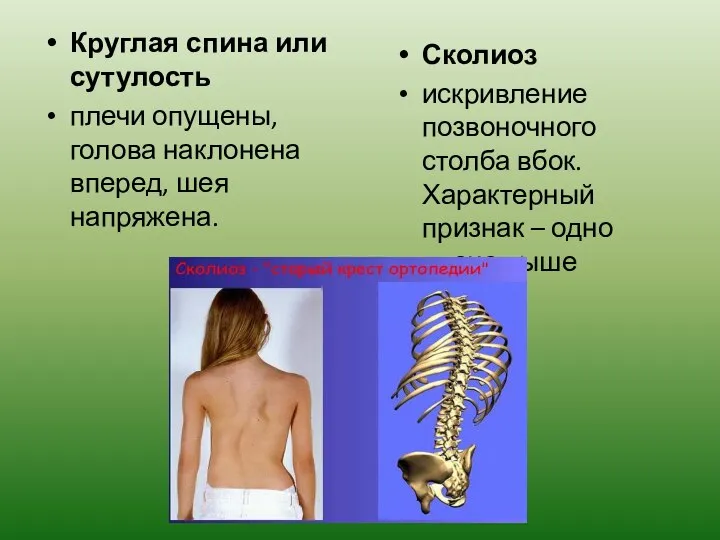 Круглая спина или сутулость плечи опущены, голова наклонена вперед, шея напряжена.