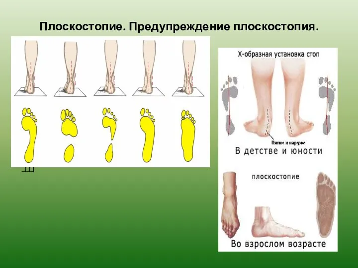 Плоскостопие. Предупреждение плоскостопия.