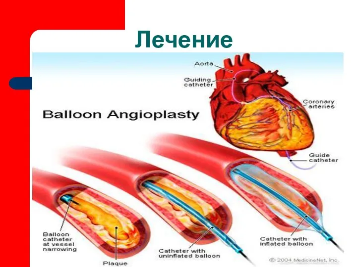 Лечение восстановления коронарного кровотока