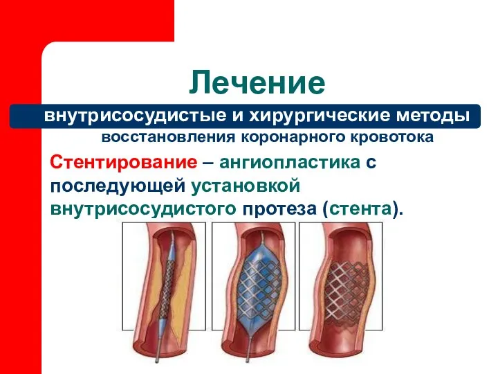 Лечение внутрисосудистые и хирургические методы восстановления коронарного кровотока Стентирование – ангиопластика