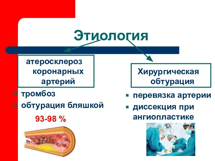 Этиология атеросклероз коронарных артерий Хирургическая обтурация тромбоз обтурация бляшкой перевязка артерии диссекция при ангиопластике 93-98 %