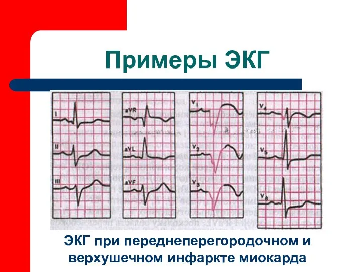 Примеры ЭКГ ЭКГ при переднеперегородочном и верхушечном инфаркте миокарда