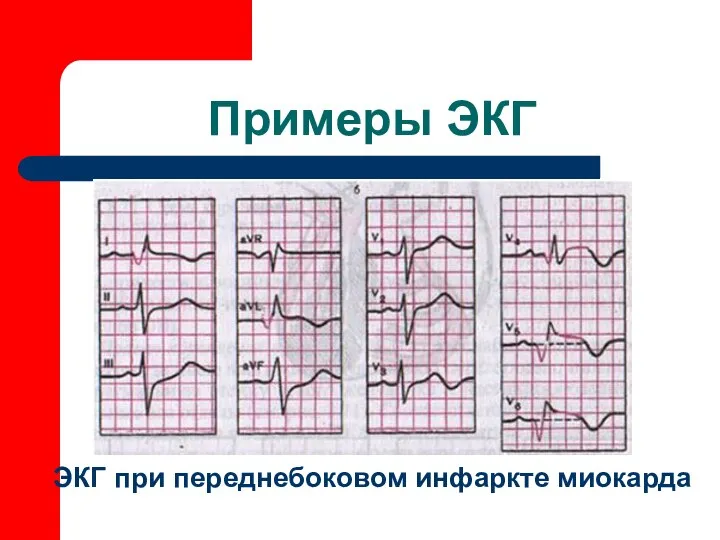 Примеры ЭКГ ЭКГ при переднебоковом инфаркте миокарда