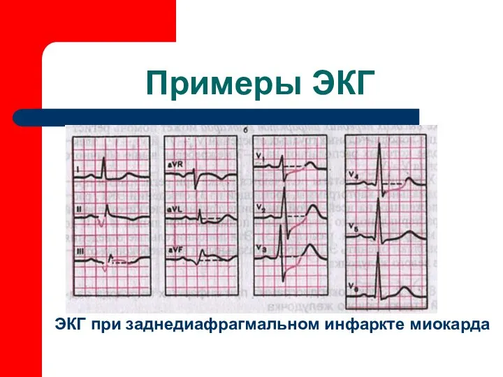 Примеры ЭКГ ЭКГ при заднедиафрагмальном инфаркте миокарда