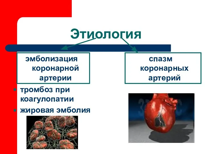 Этиология эмболизация коронарной артерии спазм коронарных артерий тромбоз при коагулопатии жировая эмболия