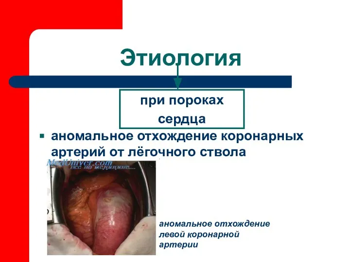 Этиология при пороках сердца аномальное отхождение коронарных артерий от лёгочного ствола аномальное отхождение левой коронарной артерии