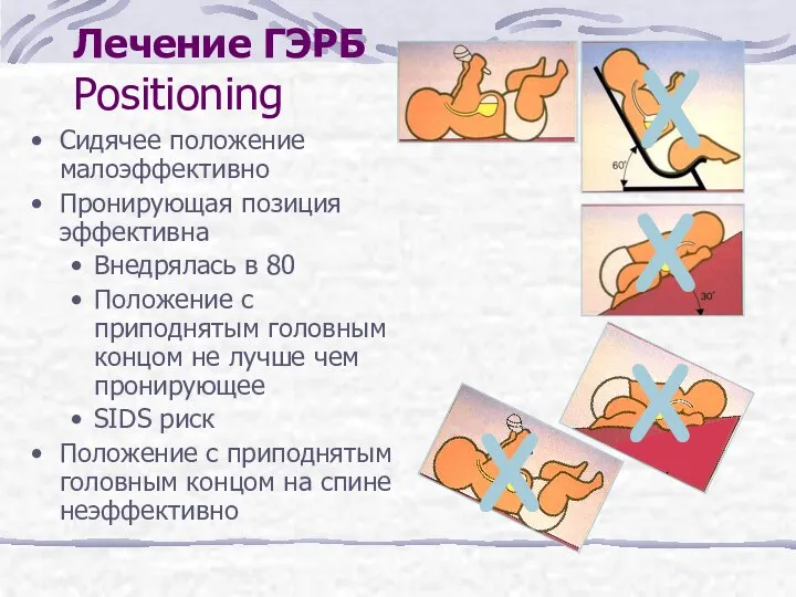 Лечение ГЭРБ Positioning Сидячее положение малоэффективно Пронирующая позиция эффективна Внедрялась в