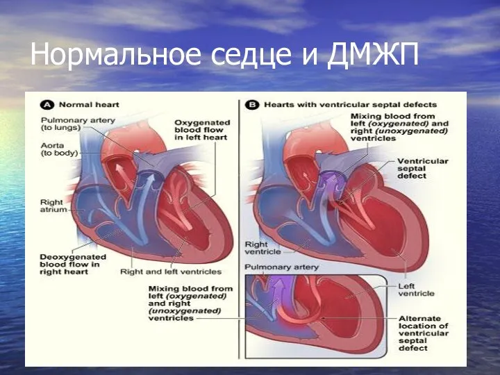 Нормальное седце и ДМЖП