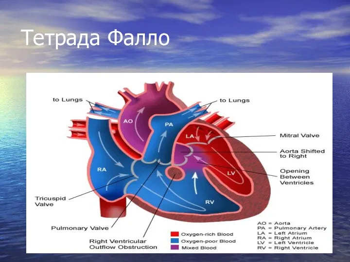 Тетрада Фалло