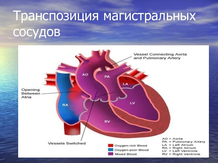 Транспозиция магистральных сосудов