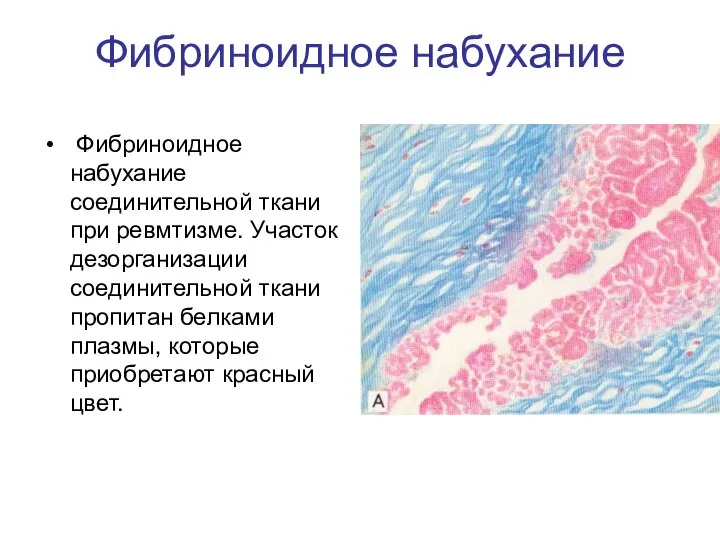 Фибриноидное набухание Фибриноидное набухание соединительной ткани при ревмтизме. Участок дезорганизации соединительной