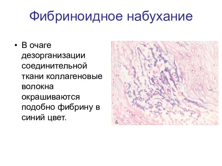 Фибриноидное набухание В очаге дезорганизации соединительной ткани коллагеновые волокна окрашиваются подобно фибрину в синий цвет.