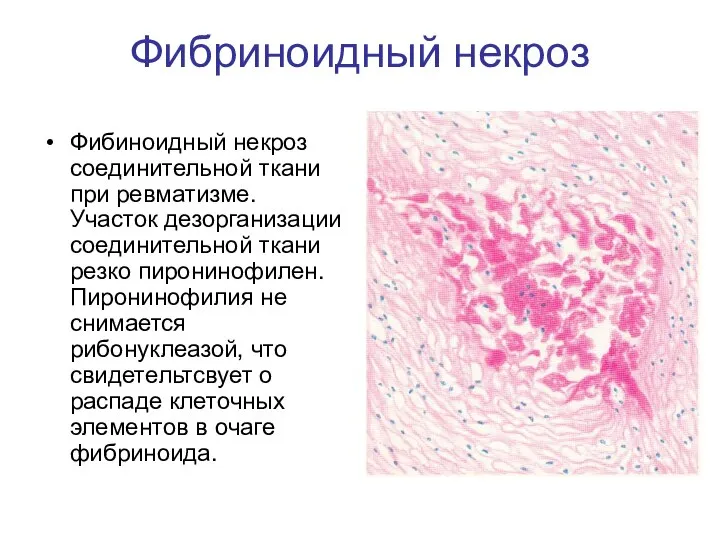 Фибриноидный некроз Фибиноидный некроз соединительной ткани при ревматизме. Участок дезорганизации соединительной