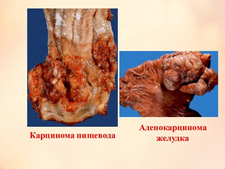Аденокарцинома желудка Карцинома пищевода