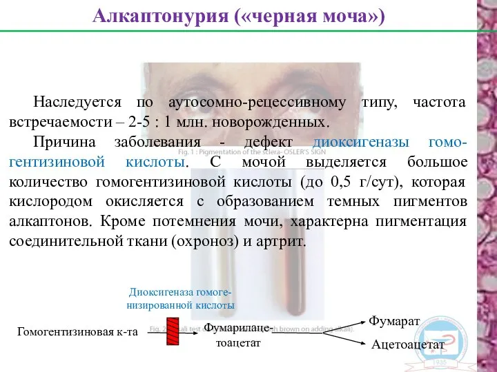 Наследуется по аутосомно-рецессивному типу, частота встречаемости – 2-5 : 1 млн.