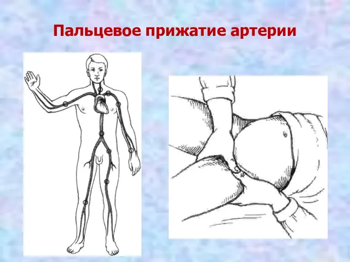 Пальцевое прижатие артерии