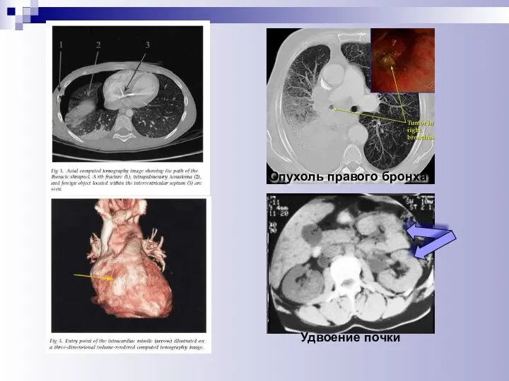 Удвоение почки Опухоль правого бронха