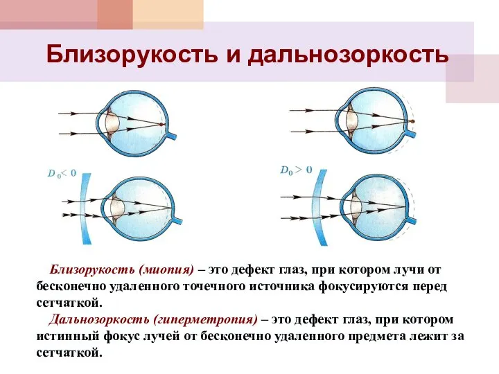 Близорукость и дальнозоркость Близорукость (миопия) – это дефект глаз, при котором