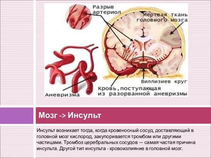 Инсульт возникает тогда, когда кровеносный сосуд, доставляющий в головной мозг кислород,