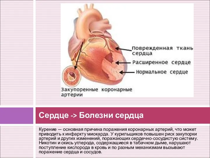 Курение — основная причина поражения коронарных артерий, что может приводить к