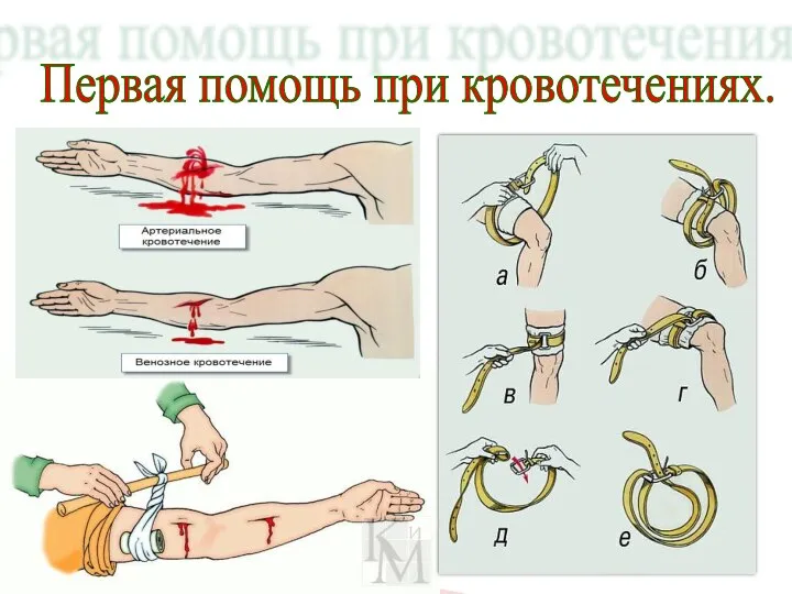 Первая помощь при кровотечениях.