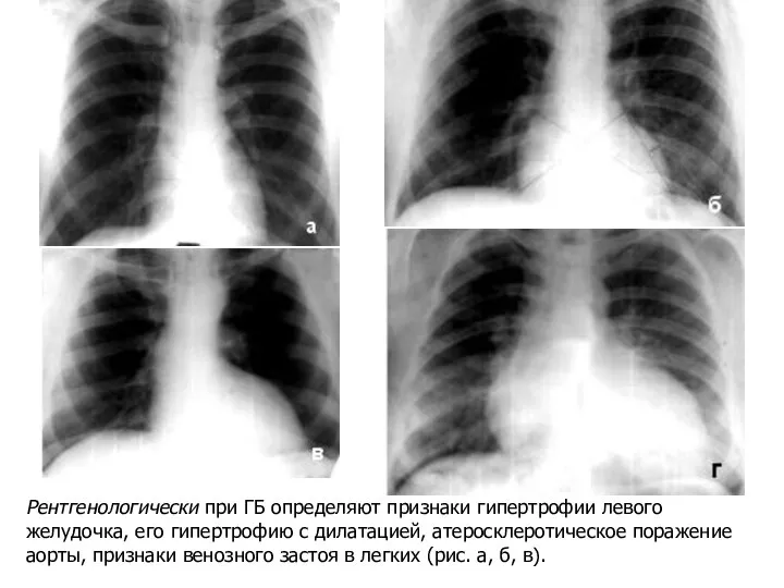 Рентгенологически при ГБ определяют признаки гипертрофии левого желудочка, его гипертрофию с