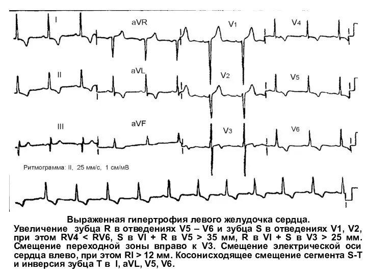 Выраженная гипертрофия левого желудочка сердца. Увеличение зубца R в отведениях V5